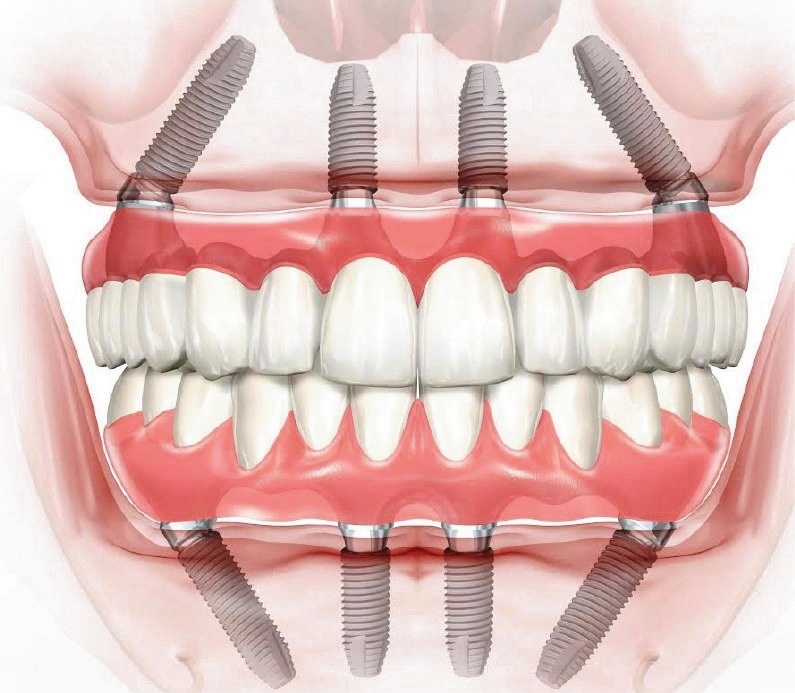 Когда необходимы зубные имплантаты?