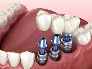 Имплантация зубов: новые технологии и возможности
