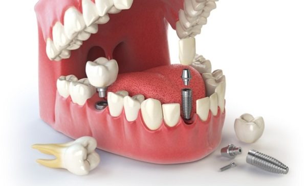 Имплантация зубов: что следует знать